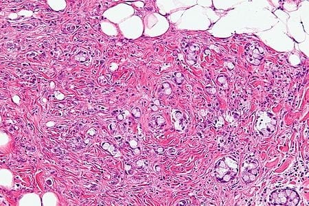 Goblet Cell Carcinoid
