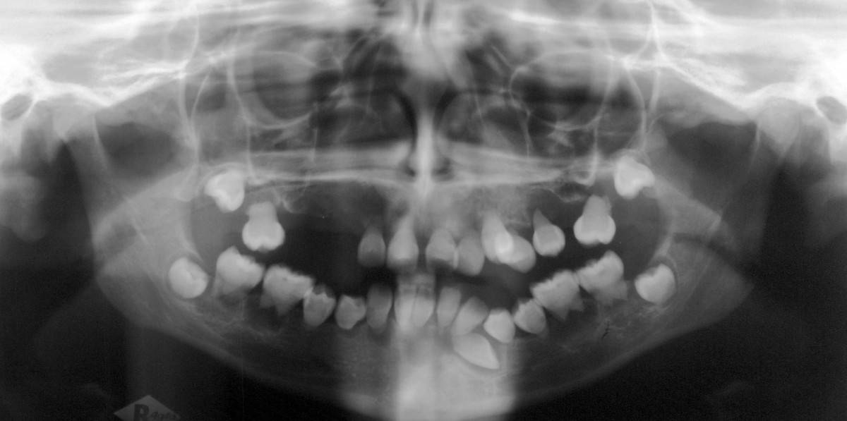 Dentin Dysplasia Type I