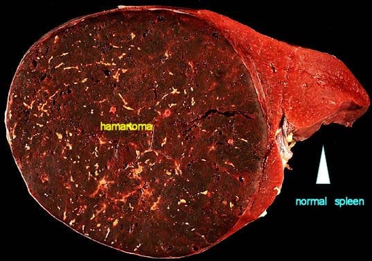 Hypothalamic Hamartoma