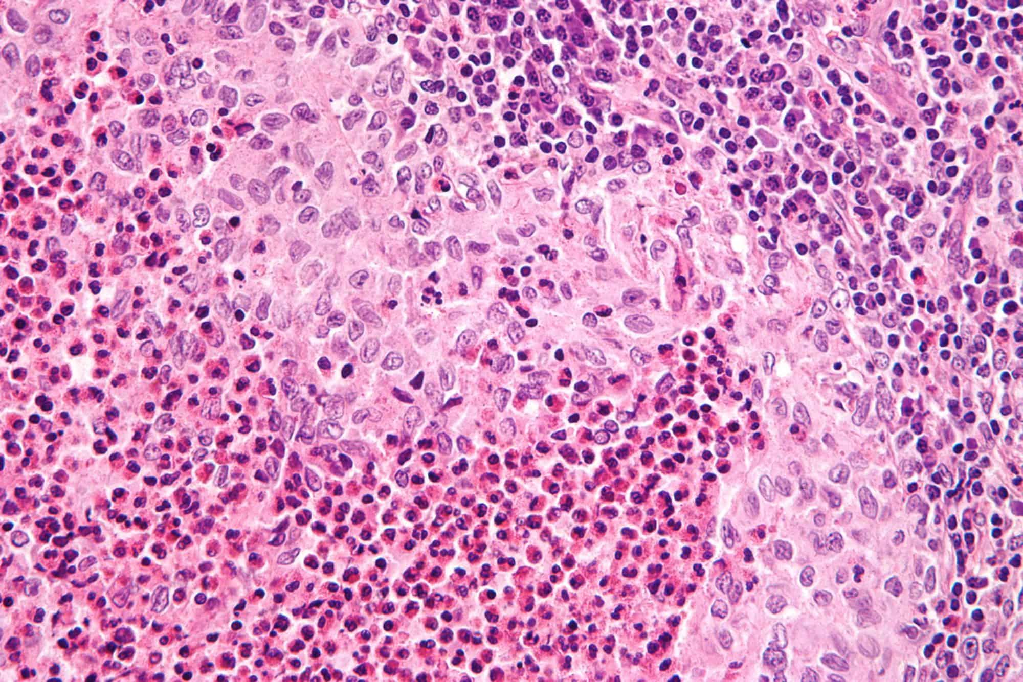 Langerhans Cell Histiocytosis