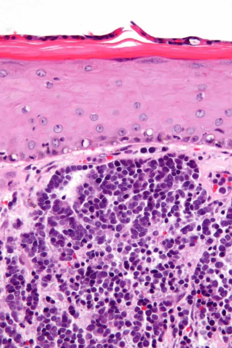 Merkel Cell Carcinoma
